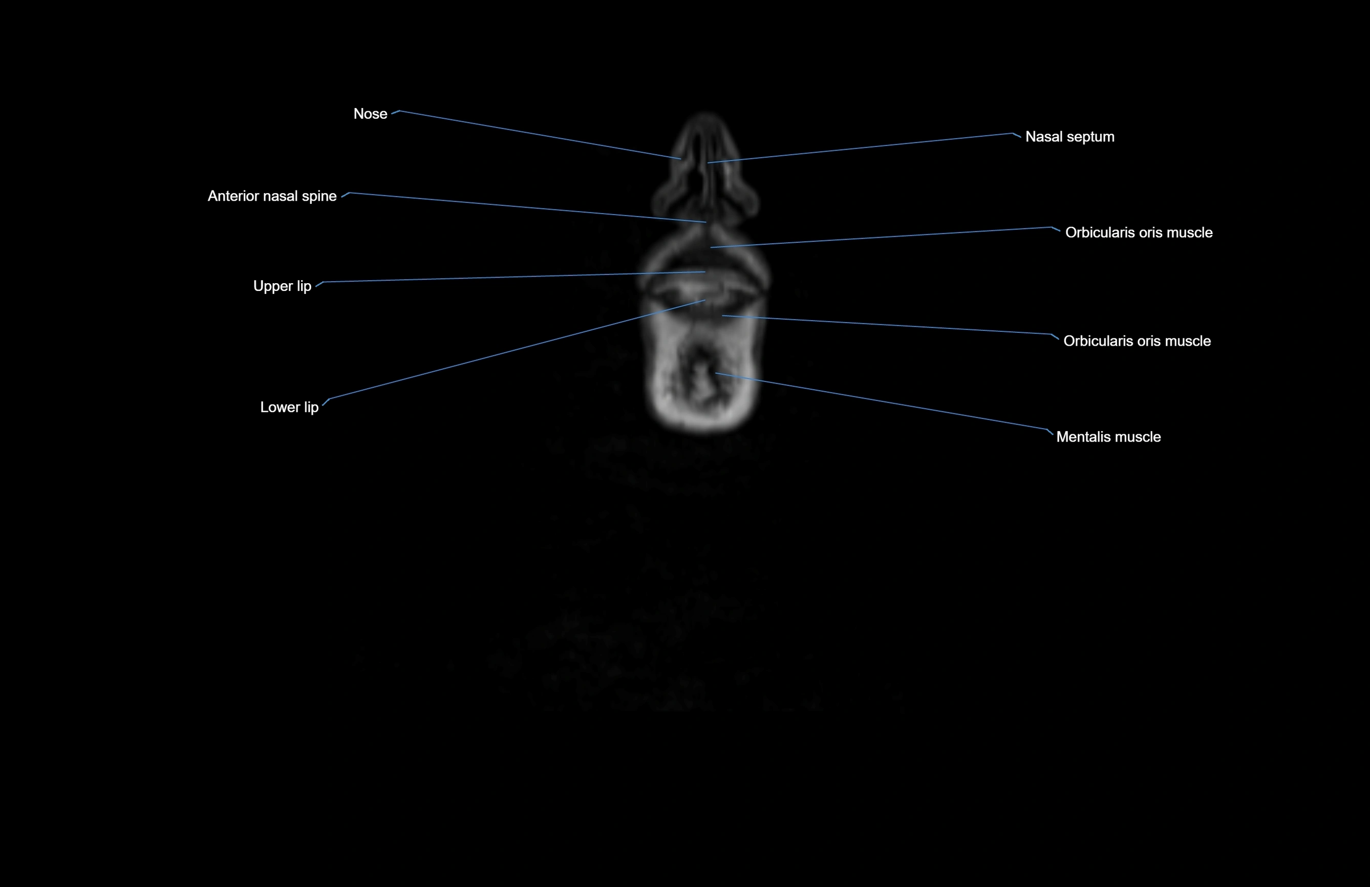 Neck coronal cross sectional MRI anatomy 3T MRI  image-img-00001-00080.webp